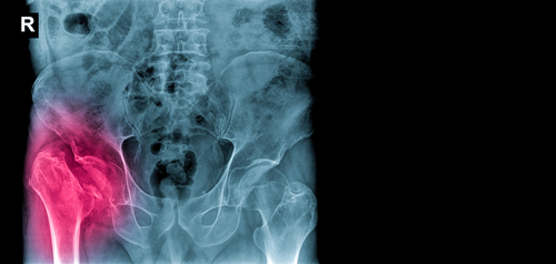 Peoria, IL nursing home injury lawyer